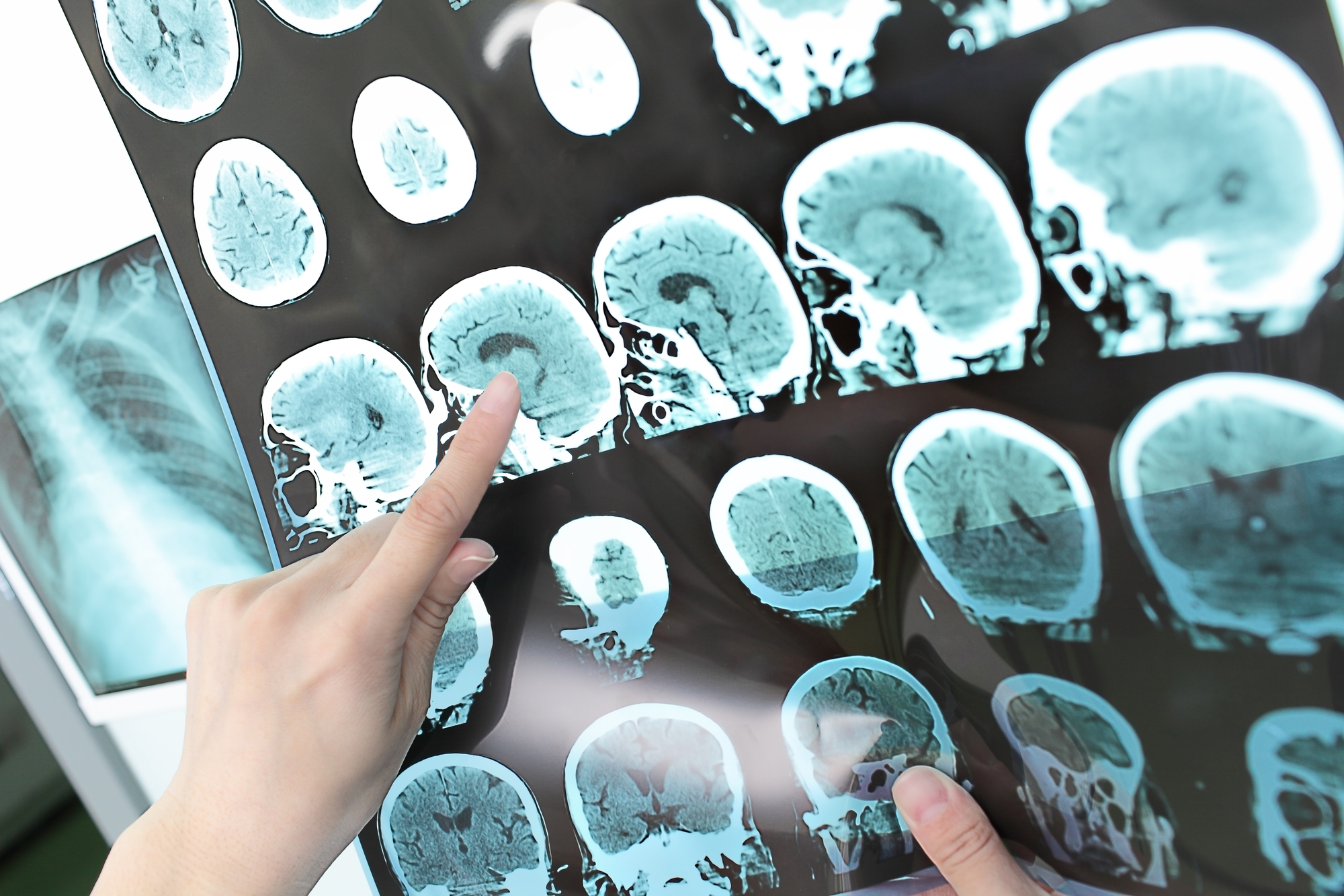 Científicos chinos reportan primer caso de Alzheimer en joven de 19 años
