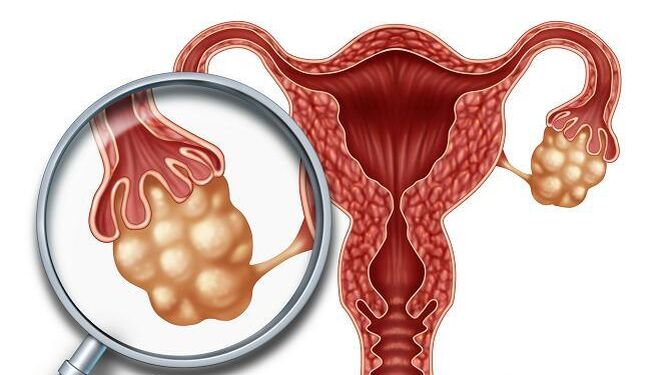 Entre 5 y 10% de las mujeres padecen el Síndrome de Ovario Poliquístico