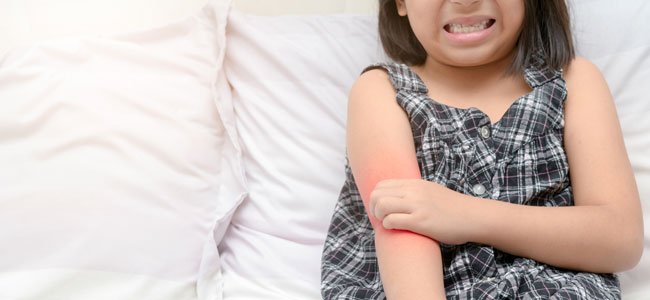El acoso escolar puede afectar a niñxs que padecen dermatitis atópica