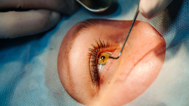 Es posible que pacientes con trasplante de córnea recuperen por completo la visión