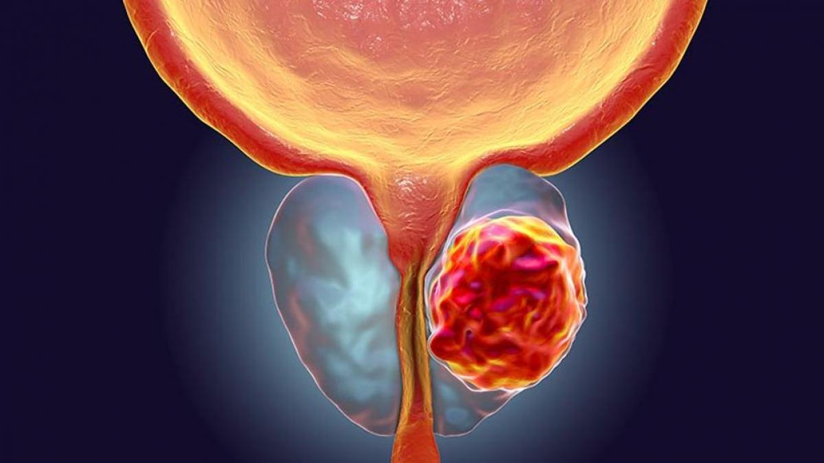 Cáncer de próstata puede ser curable con detección oportuna: INCan